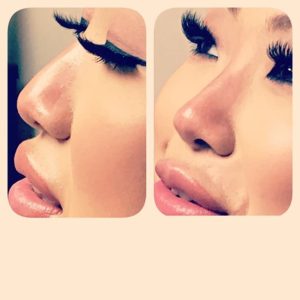 Guelph Lip fillers, botox and rhinoplasty