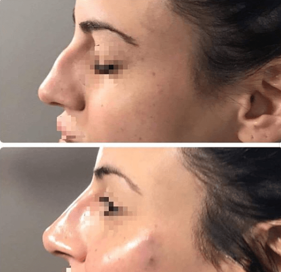 non surgical rhinoplasty in Burlington