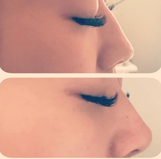 Non Surgical Rhinoplasty in Oakville