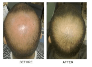 Niagara Falls Hair Restoration