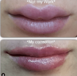 Mississauga Lip Fillers